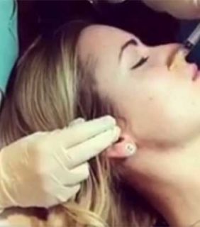 Mezoterapije lica nakon dve nedelje